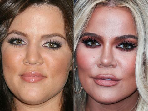 Khloe Kardashian Plastic Surgery: Before, After Photos.